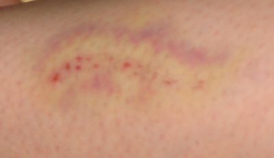 bruise 1